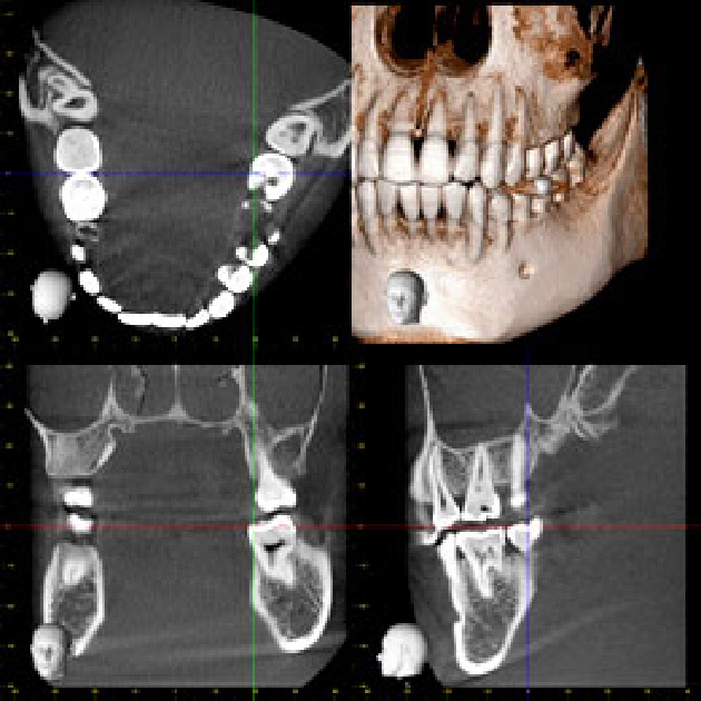 歯科用CT