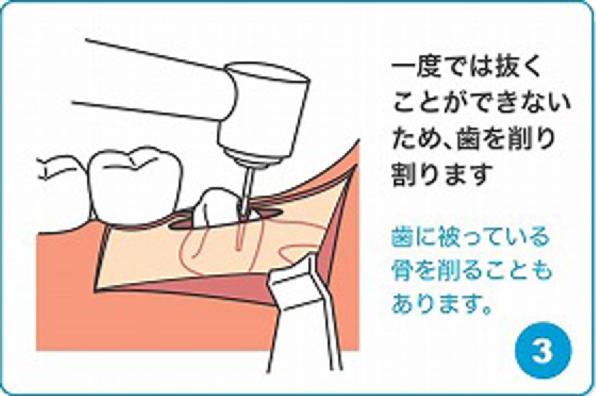 一度では抜くことができないため、歯を削り割ります