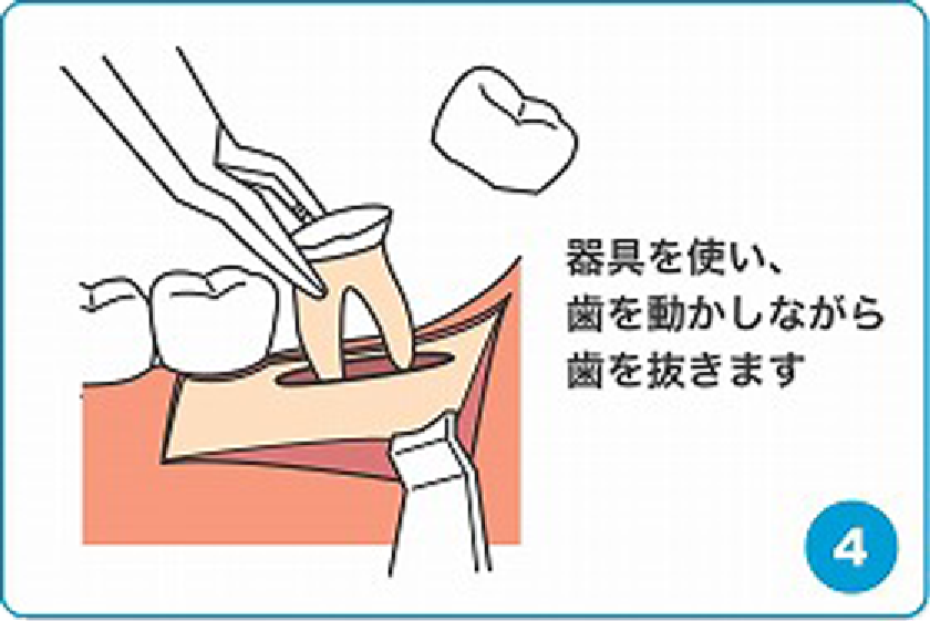 器具を使い、歯を動かしながら歯を抜きます