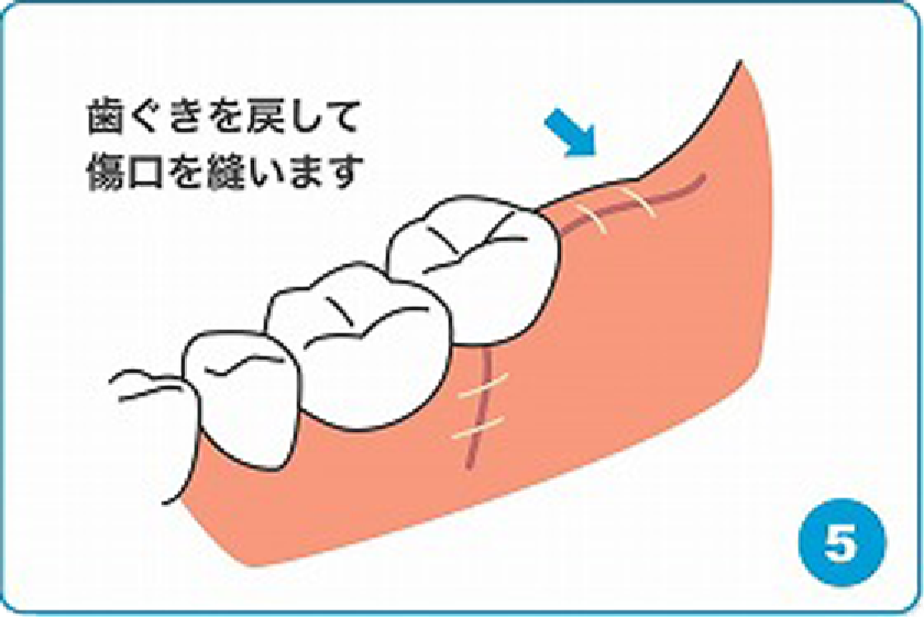 歯ぐきを戻して傷口を縫います