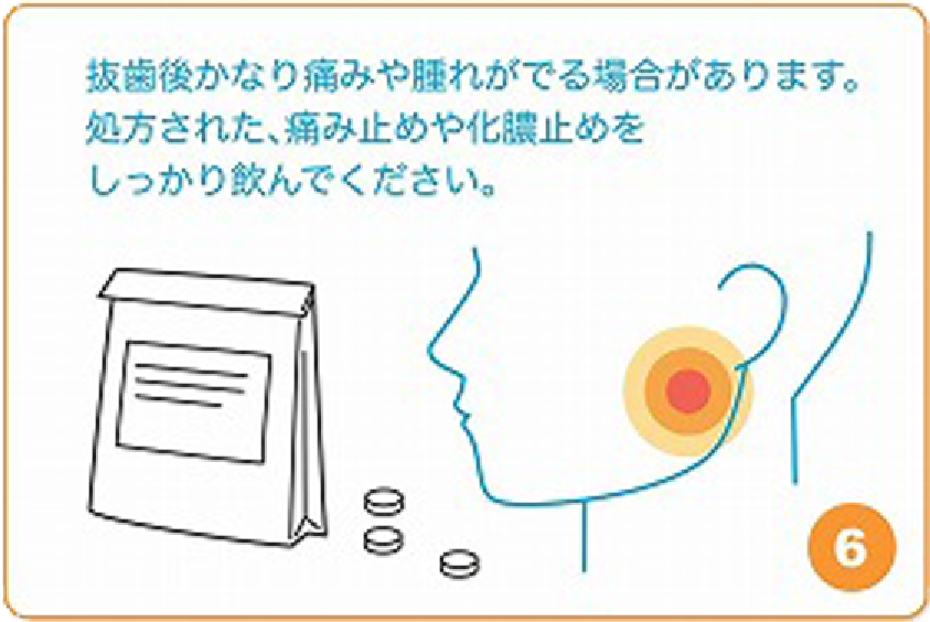 抜歯後かなり痛みや腫れが出る場合があります。処方された、痛み止めや化膿止めをしっかり飲んでください