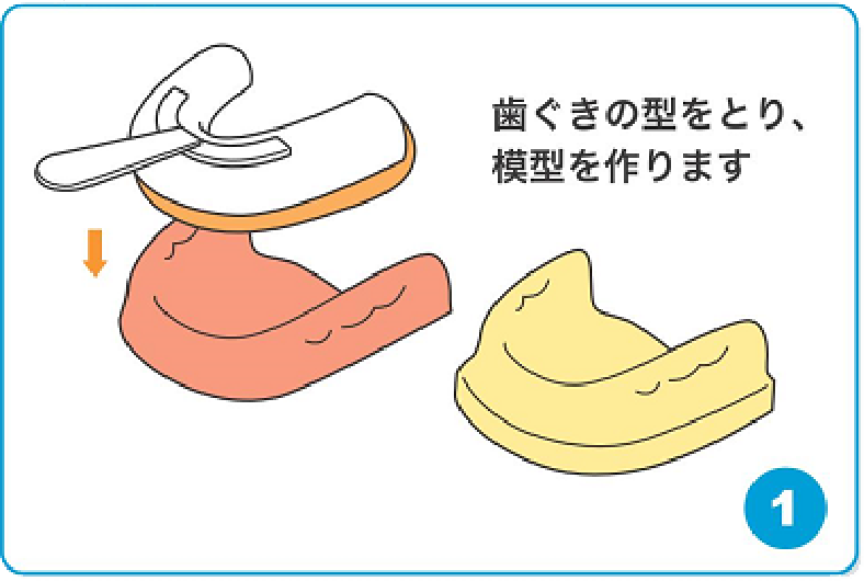 歯茎の型を取り模型を作ります