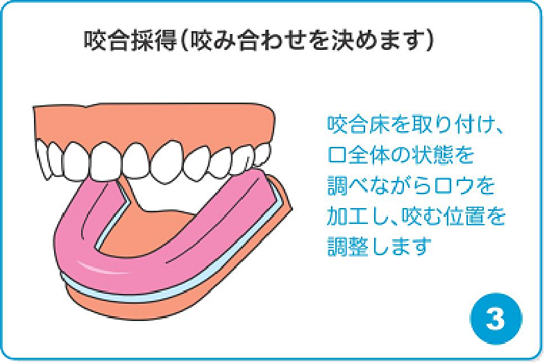 咬合採得