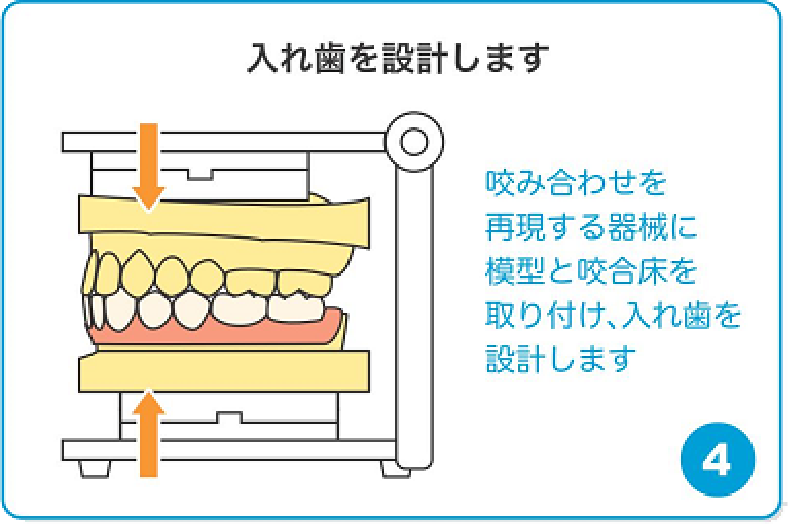 入れ歯を設計します