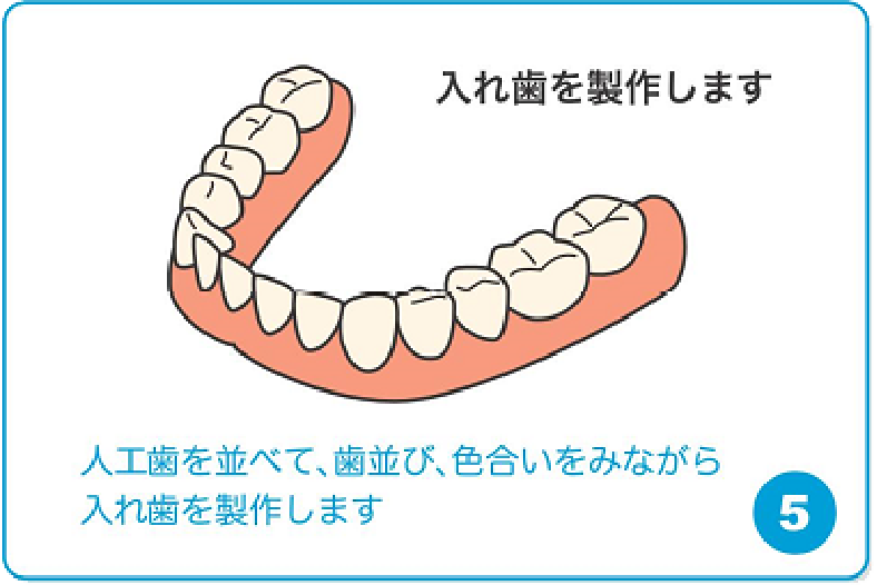 入れ歯を製作します