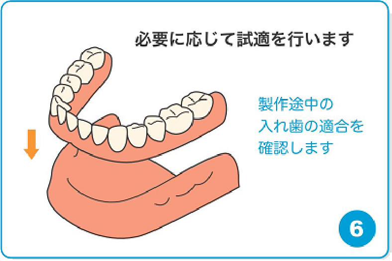 必要に応じて試適を行います