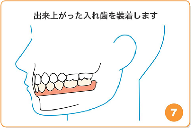 出来上がった入れ歯を装着します