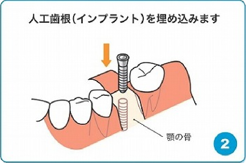 人工歯根（インプラント）を埋め込みます