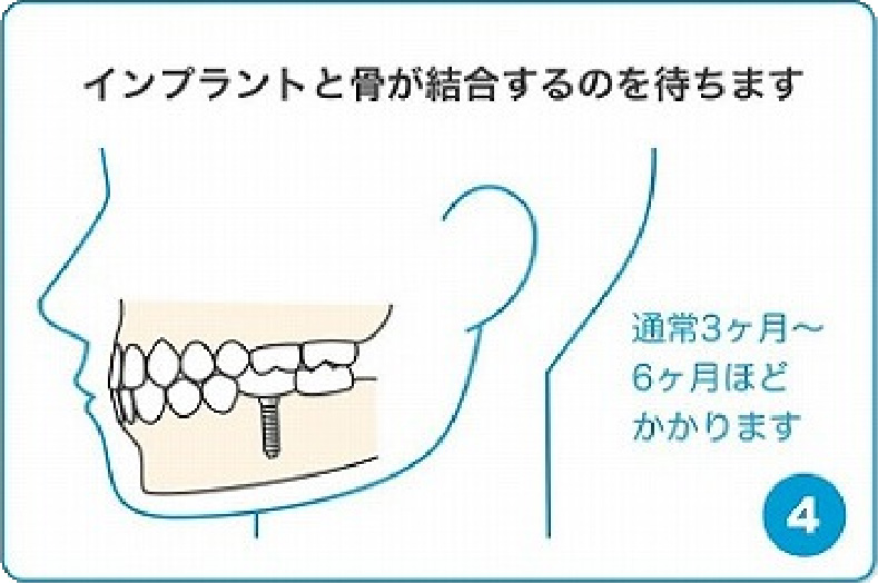 インプラントと骨が結合するのを待ちます