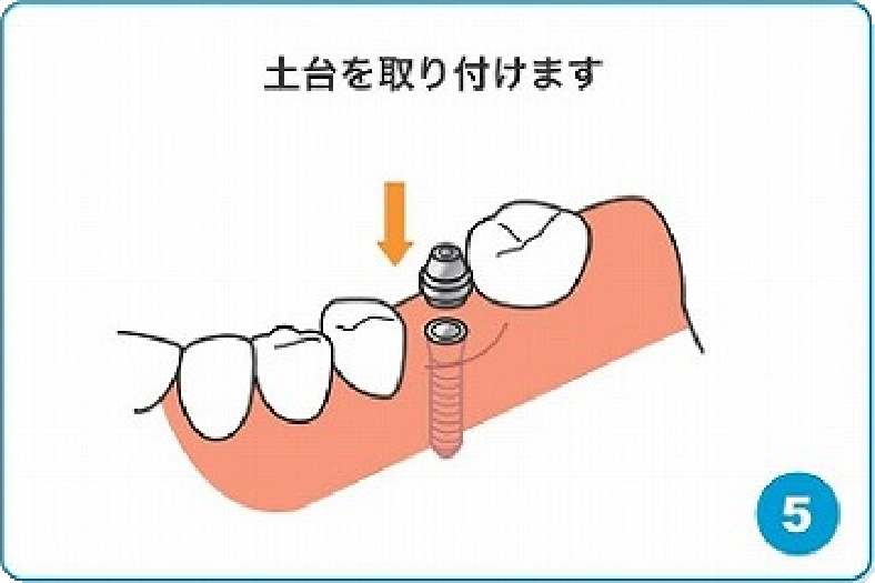 土台を取り付けます