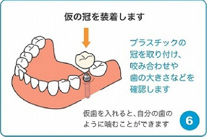 仮の冠を装着します