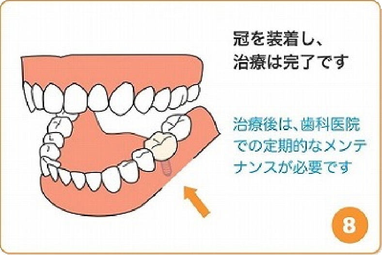 冠を装着し、治療は完了です