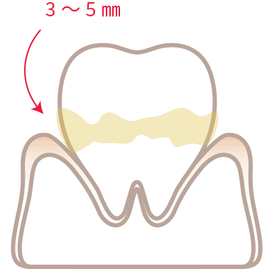 軽度の歯周炎