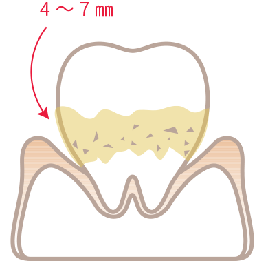 中度の歯周炎