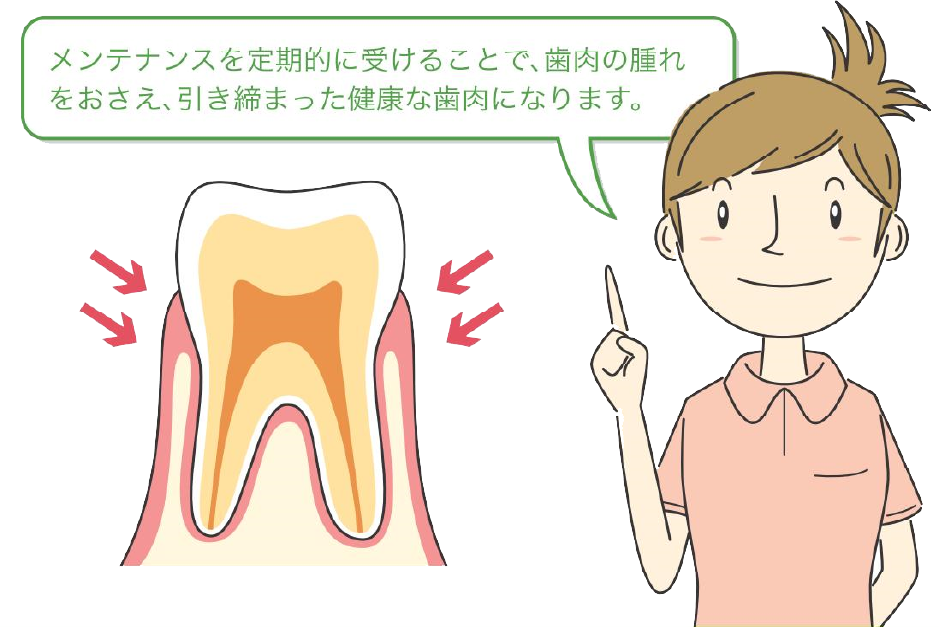 メンテナンスを定期的に受けることで、歯肉の腫れをおさえ、引き締まった健康な歯肉になります。